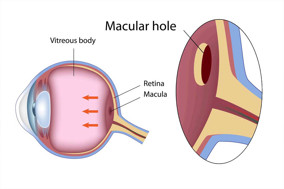 macular hole