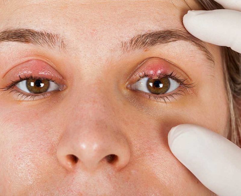 Medivision 5. Chalazion