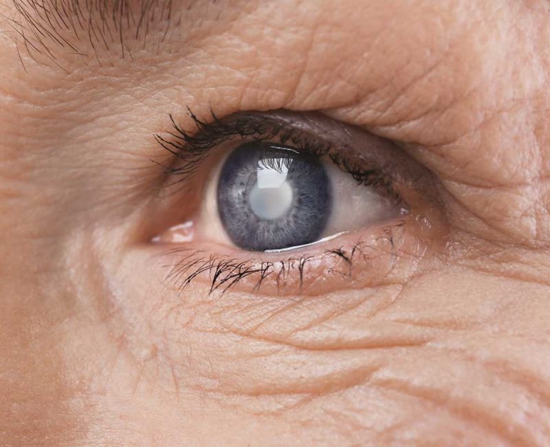 Medivision 6. Cataract